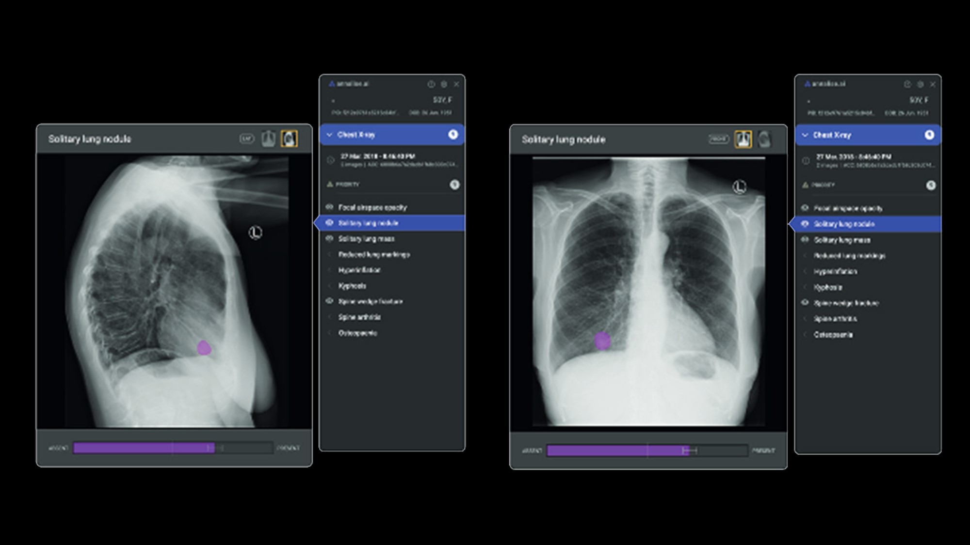 Chest Xray Interpretation Better with AI Healthcare Radius