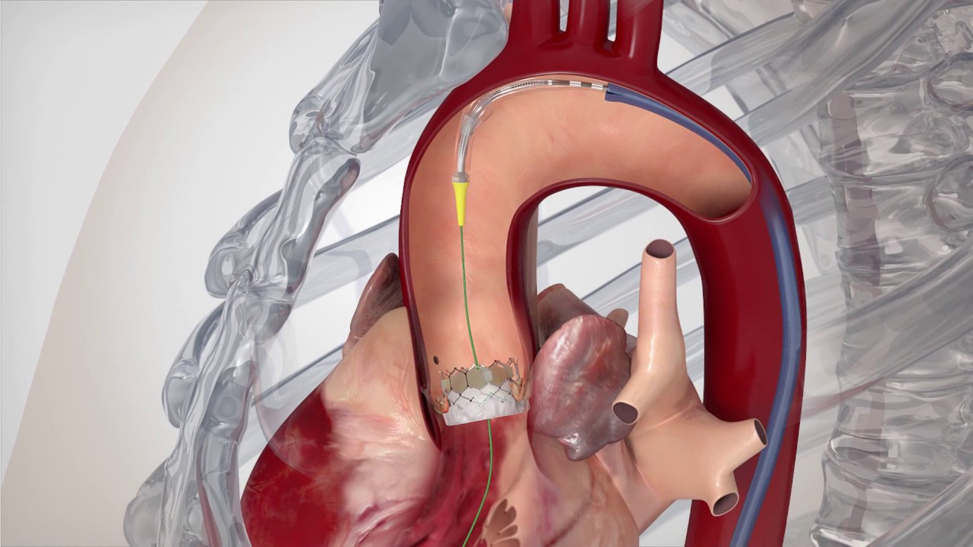 TAVI The newage lifesaving procedure for cardiac patients