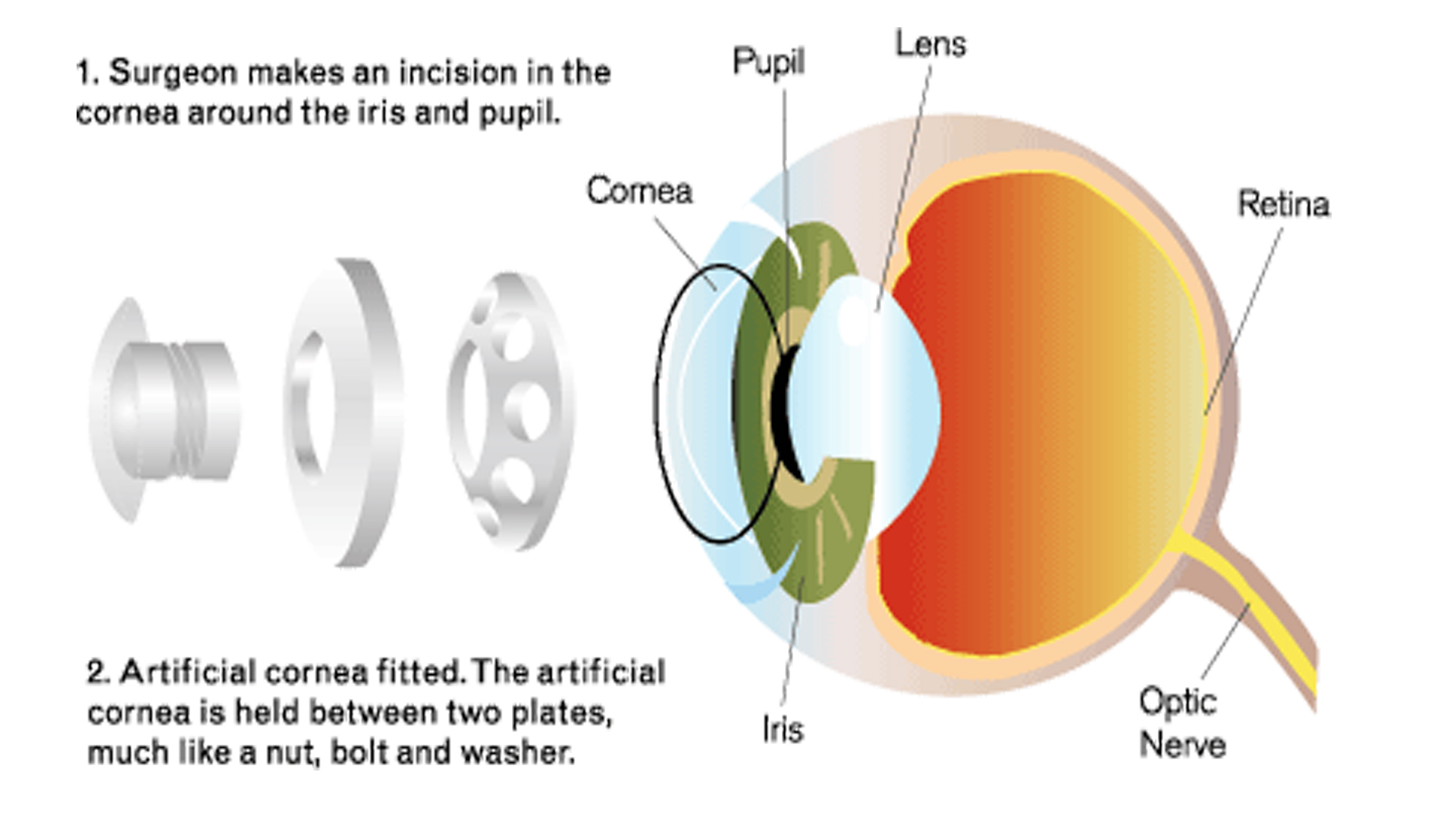Keratoprosthesis When should one opt for an artificial corneal
