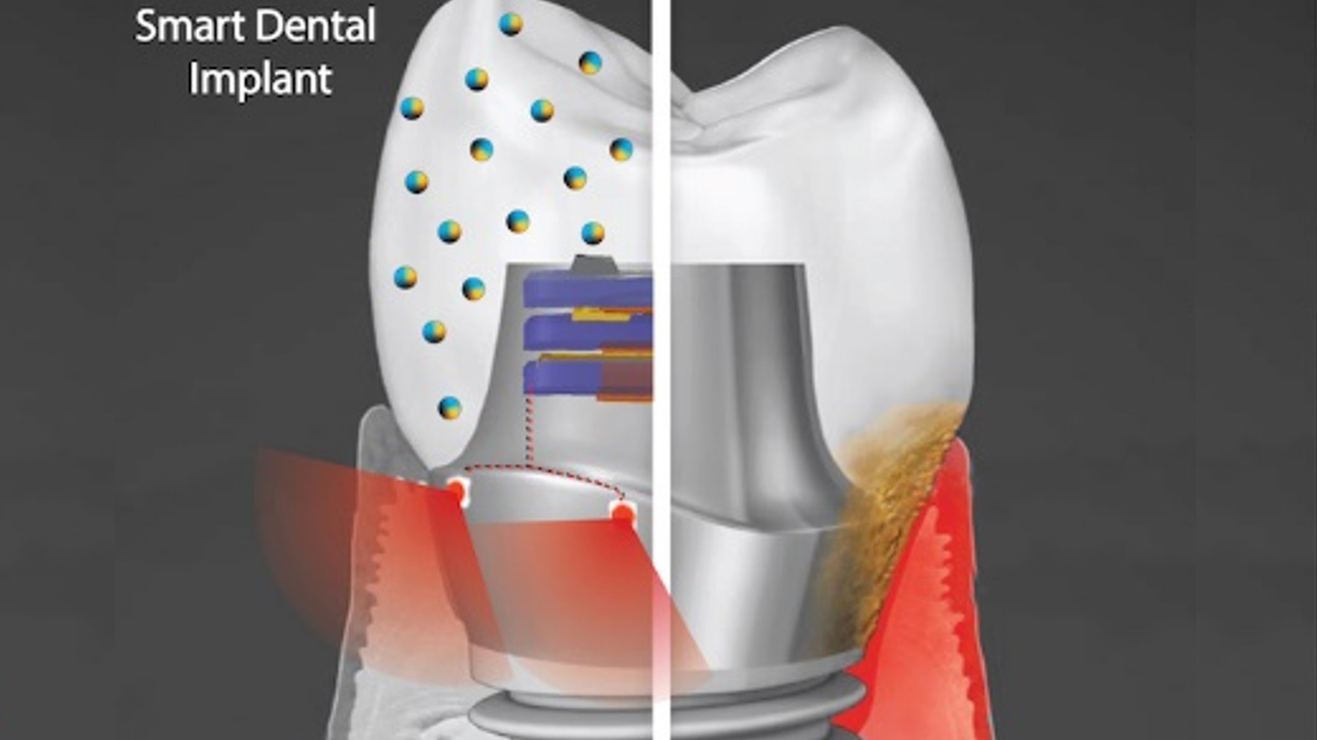 Smart dental implants that resist bacterial growth Healthcare Radius