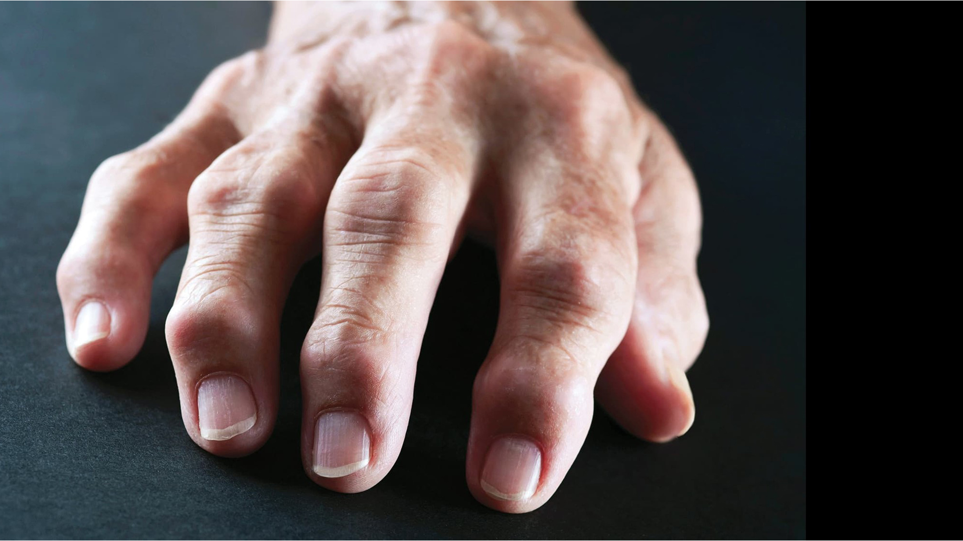 Lupin launches authorized generic version of Duexis in the US