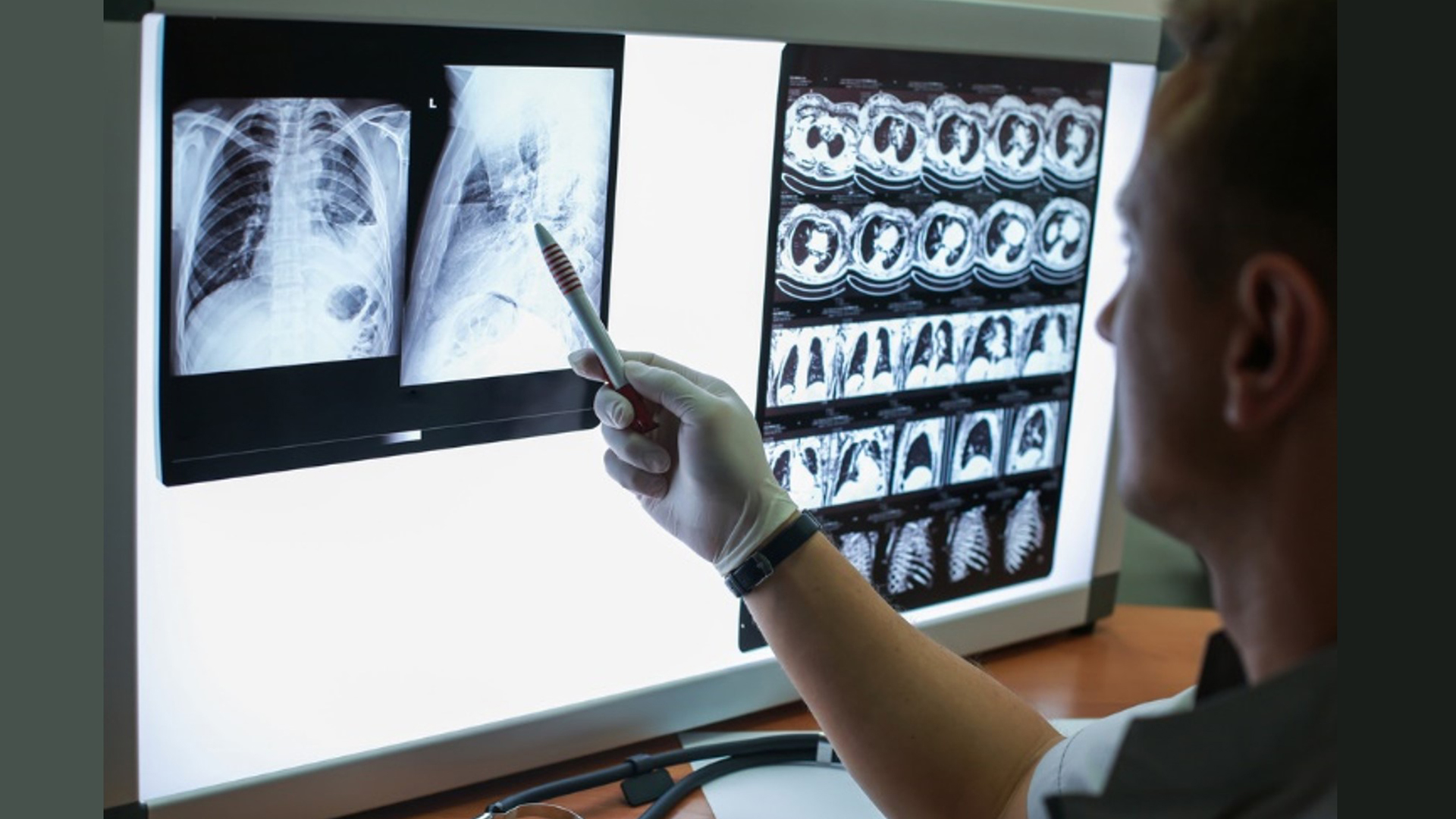 0.55T MRI effective in lung imaging Healthcare Radius