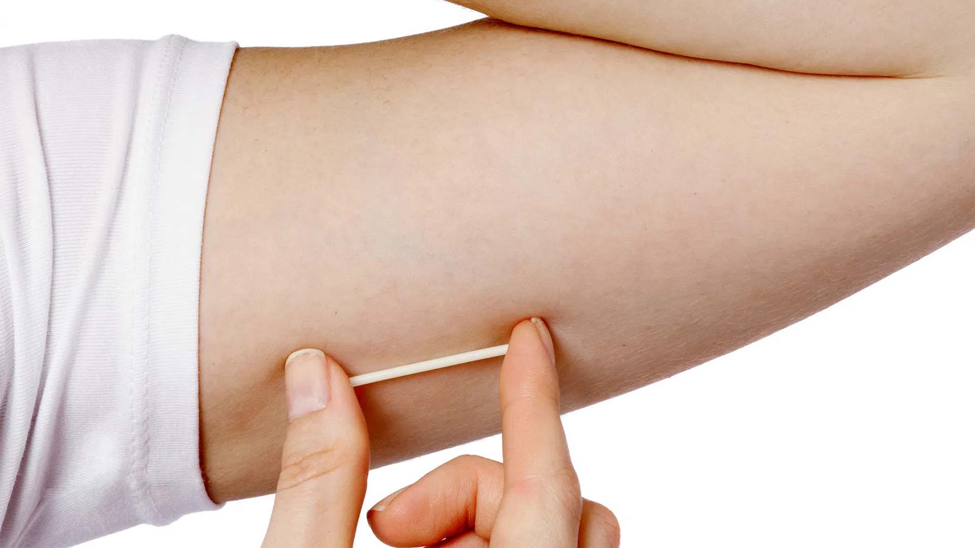 subdermal contraceptive implants