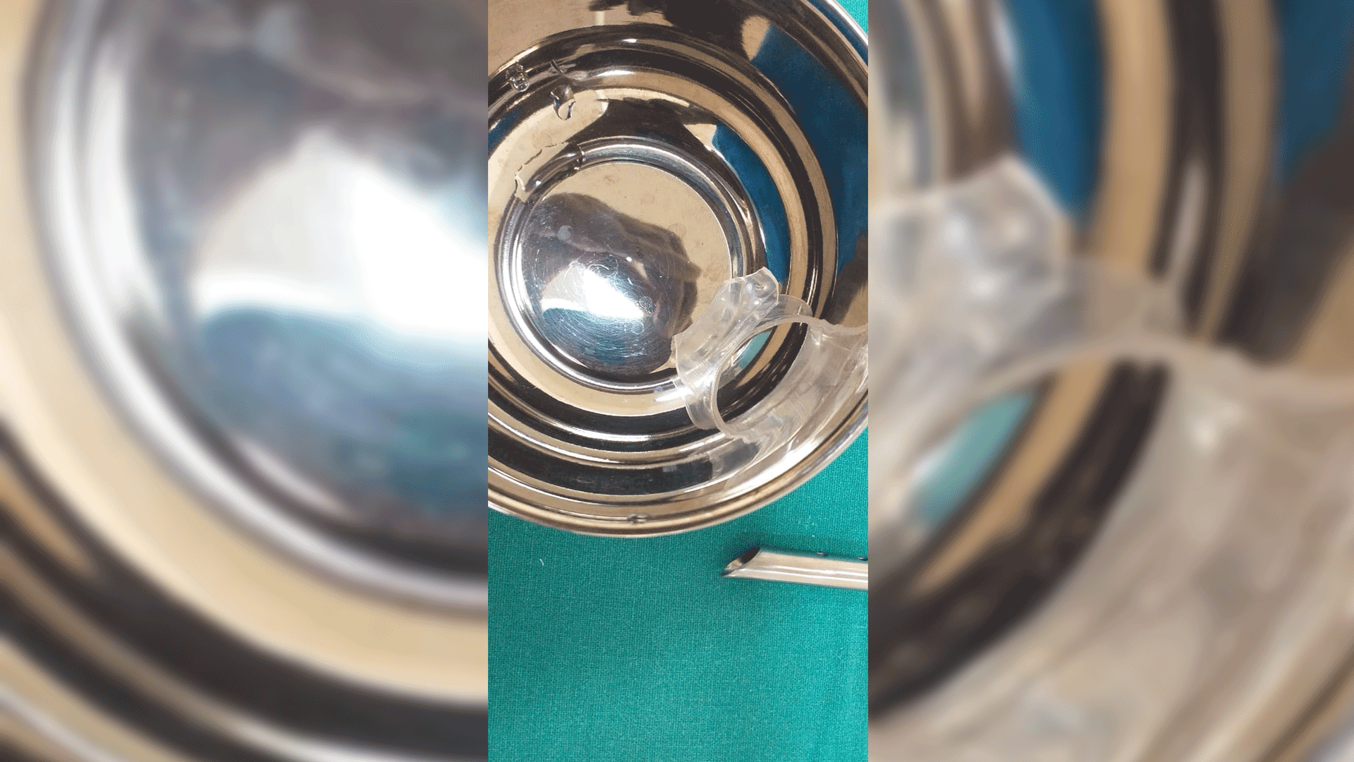 Wockhardt Hospital remove 1.5 inch bottle cap stuck in an infant’s throat Healthcare Radius