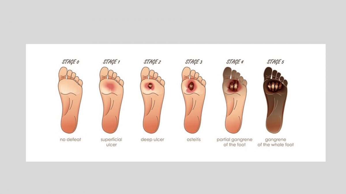 Tips for diabetes foot care during winters Healthcare Radius