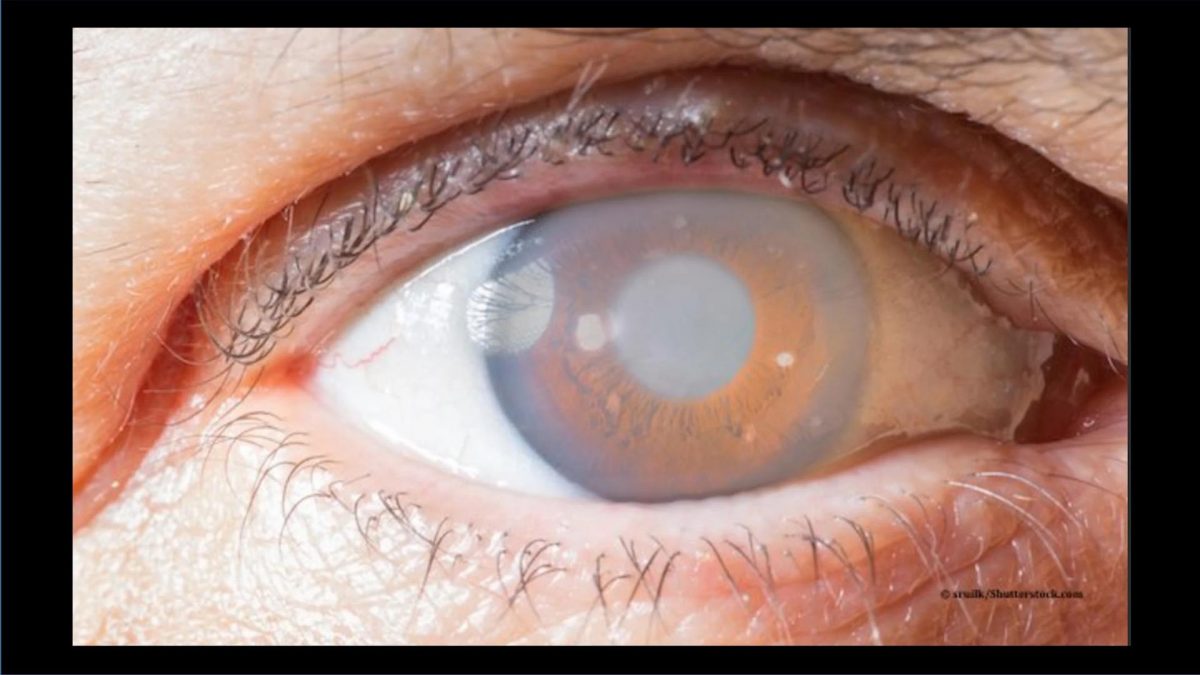 eye disorder is expected to double in India by 2040