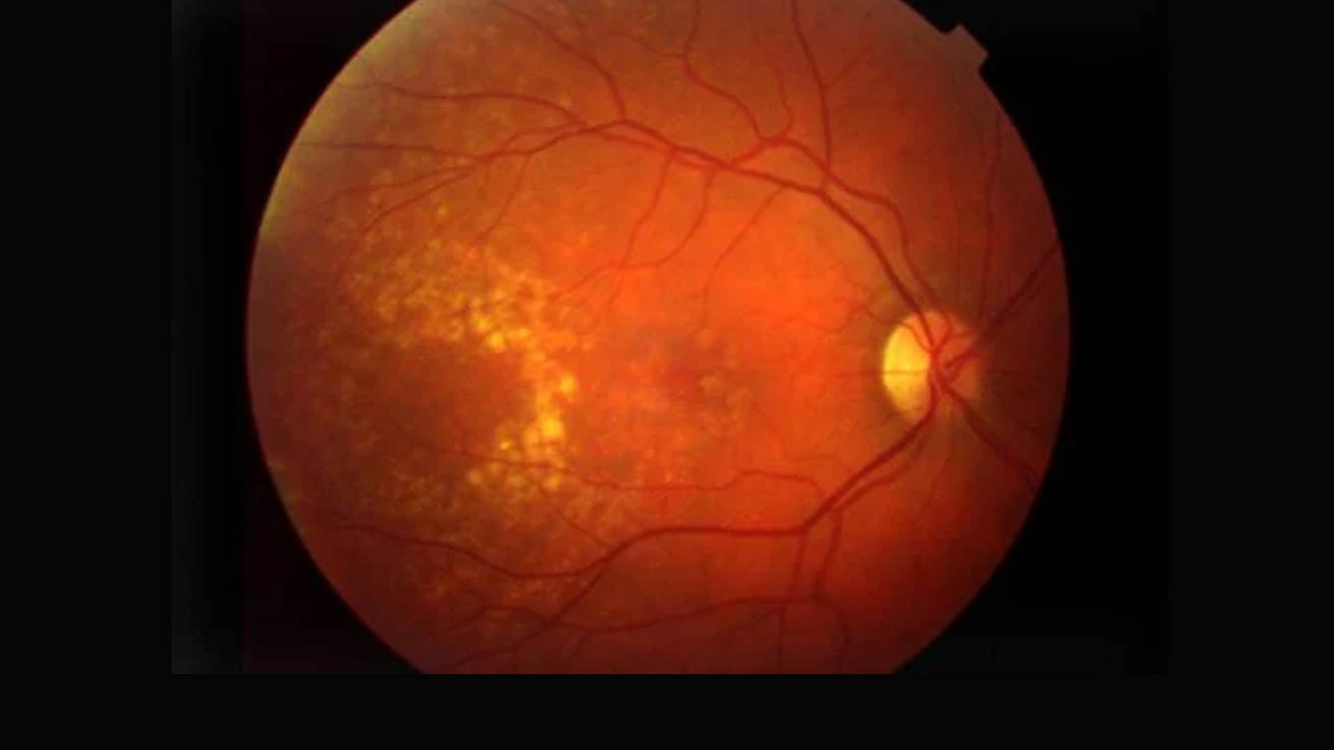 Eyestem Research moves one step closer to finding a treatment for Dry