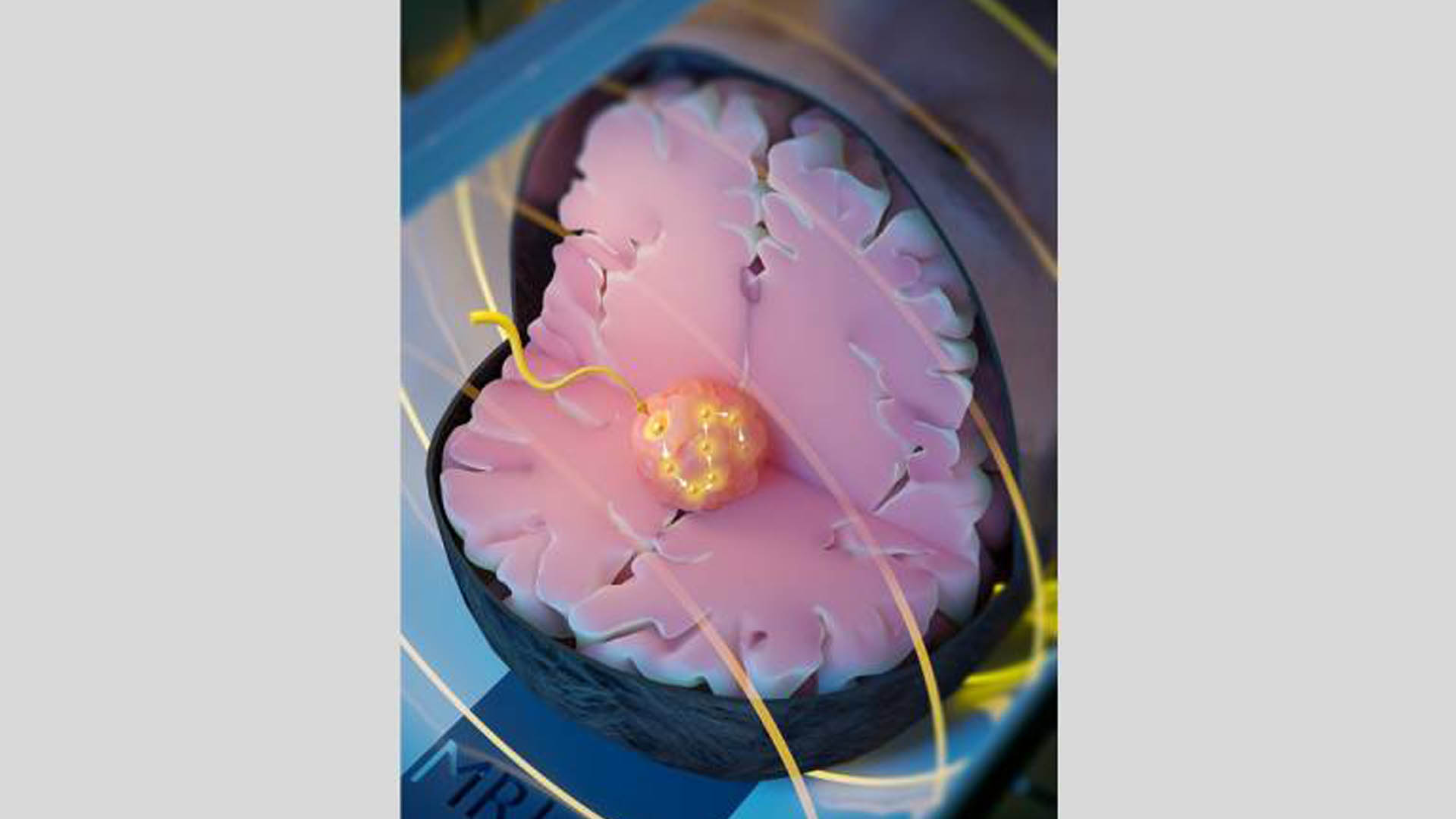 seeds used to heat and kill cancer Healthcare Radius