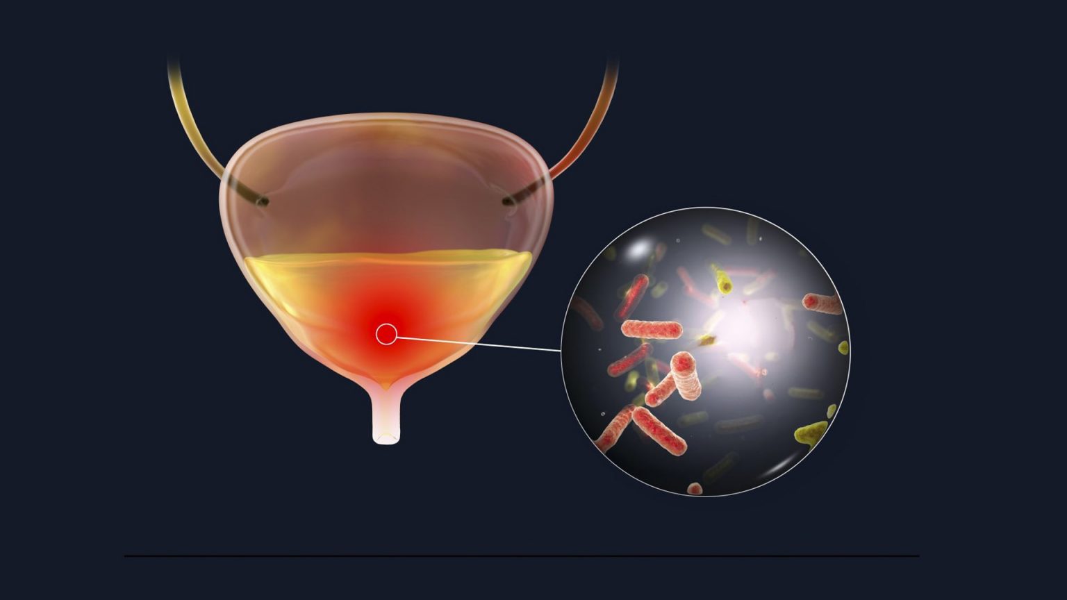 Nonantibiotic treatment shows promise for preventing recurrent urinary