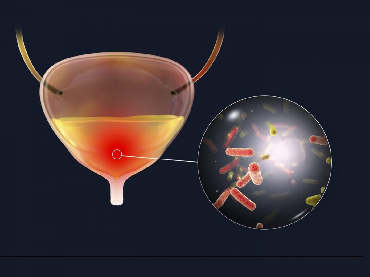 Nonantibiotic treatment shows promise for preventing recurrent urinary