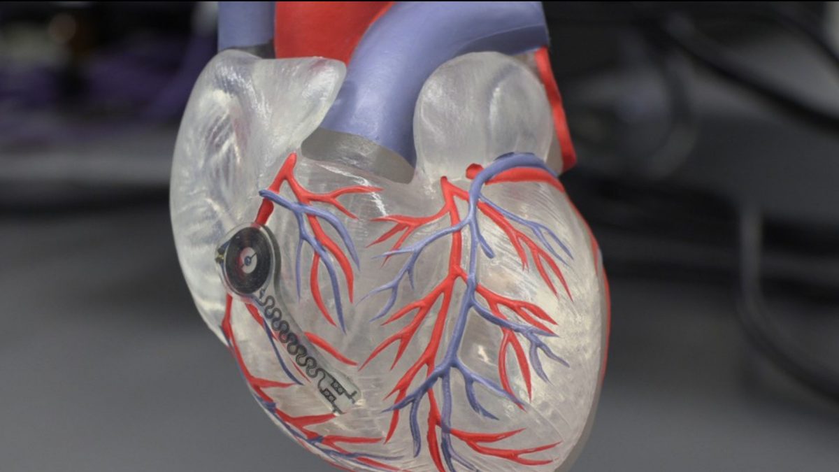 Smart, dissolving pacemaker communicates with bodyarea sensor and control network Healthcare