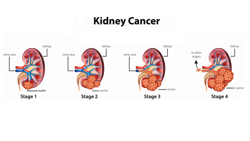 Manage complex kidney cancer with robotassisted partial nephrectomy