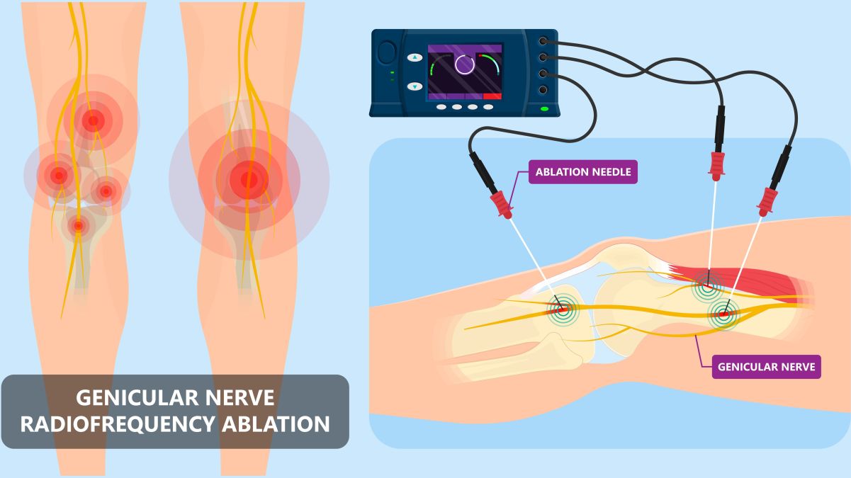 Role of radiofrequency ablation therapy in disc disease Healthcare Radius