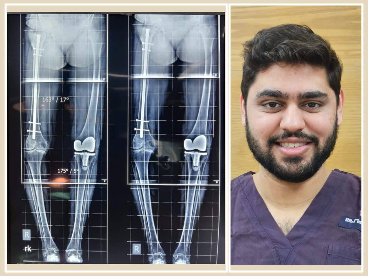 Robot-assisted surgery eases knee pain