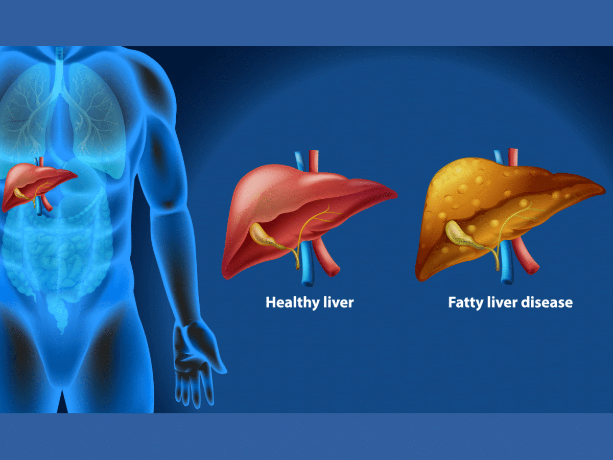 Fatty liver disease