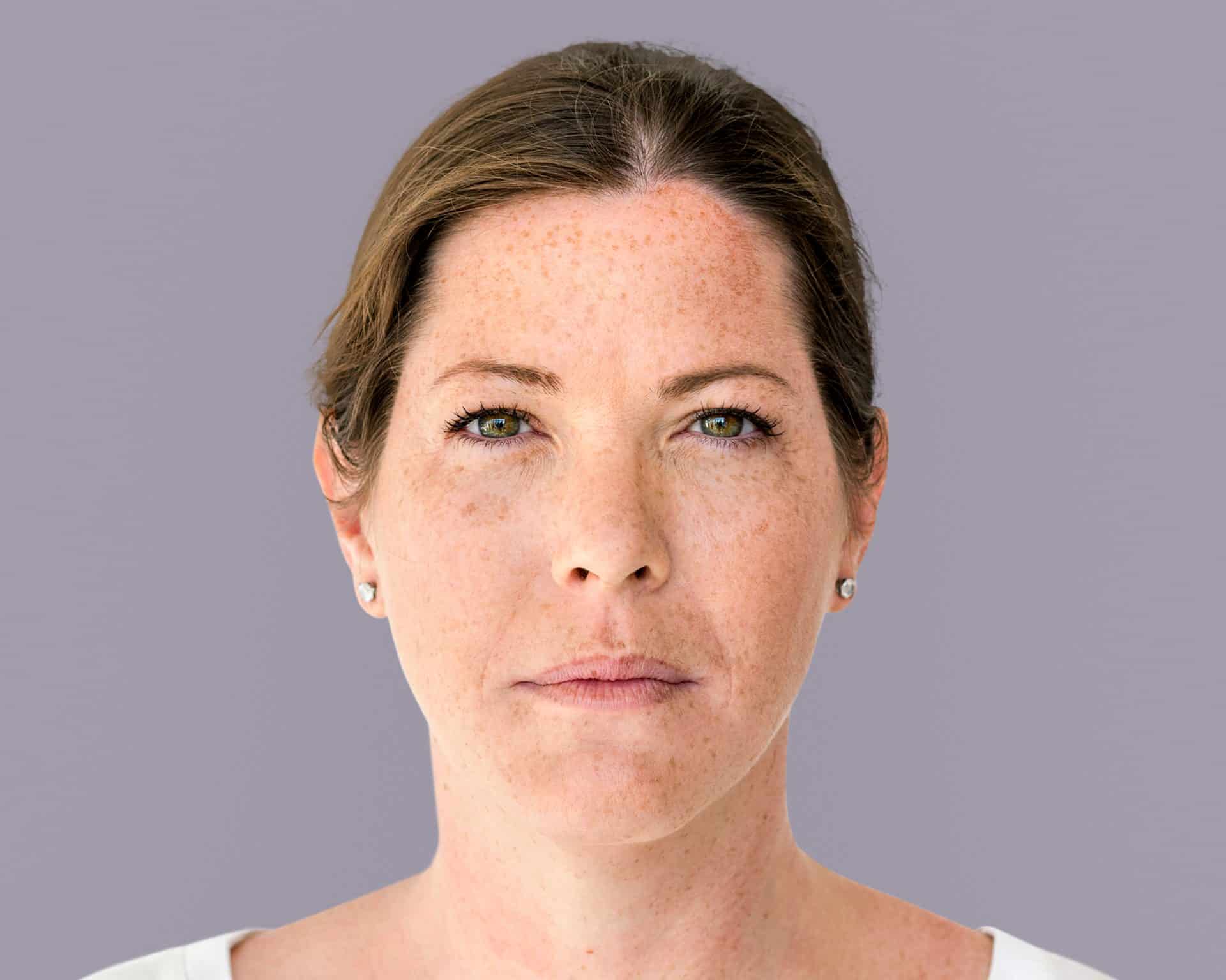hyperpigmentation