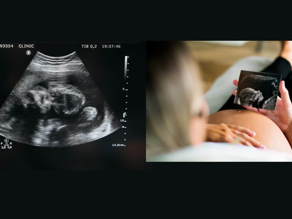 IVF Pregnancy