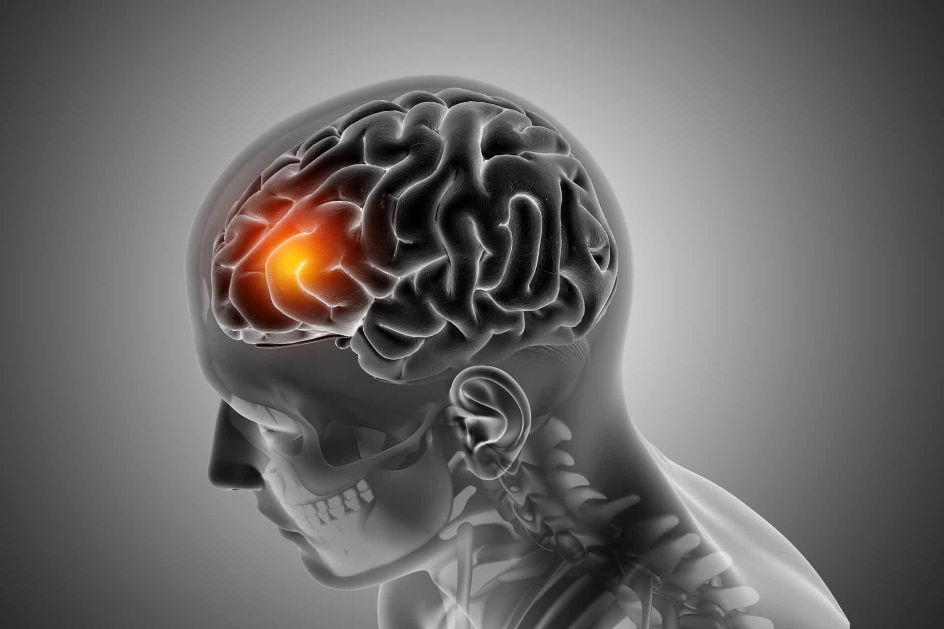 brain cancer