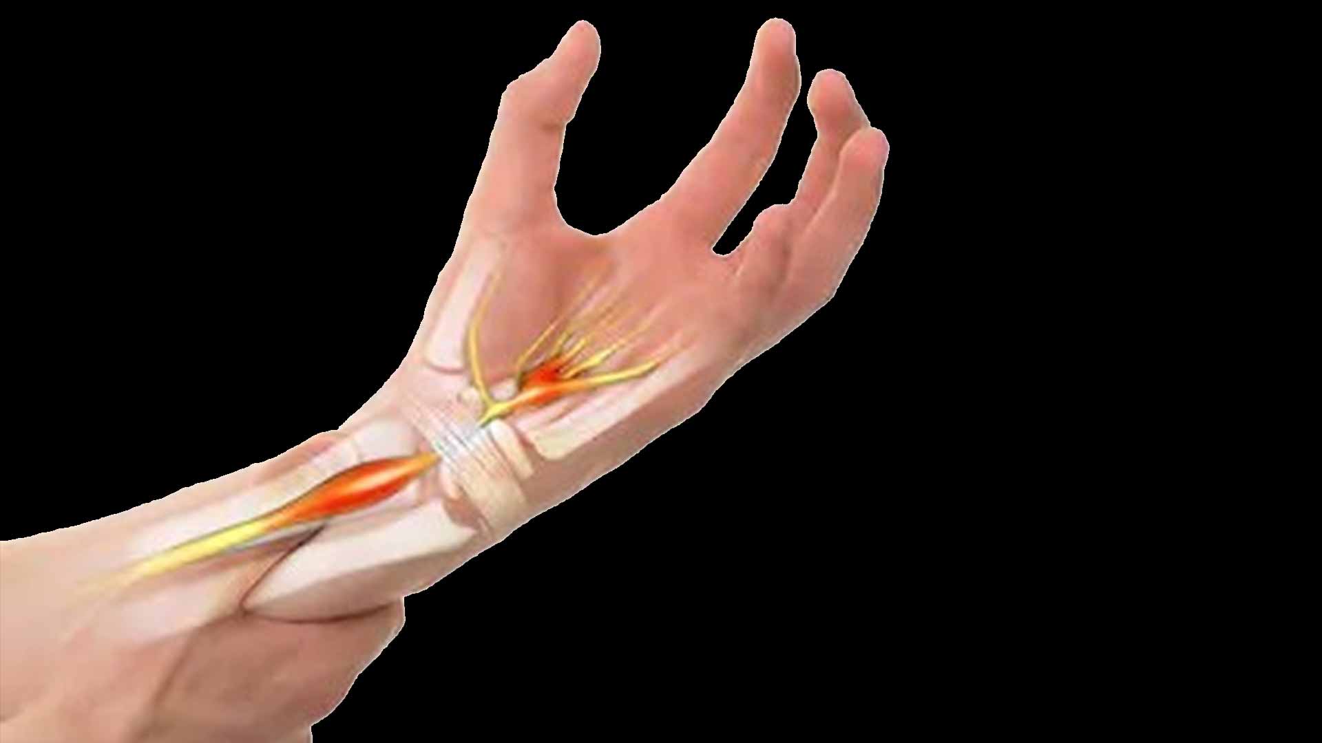 Carpal Tunnel Syndrome Hand