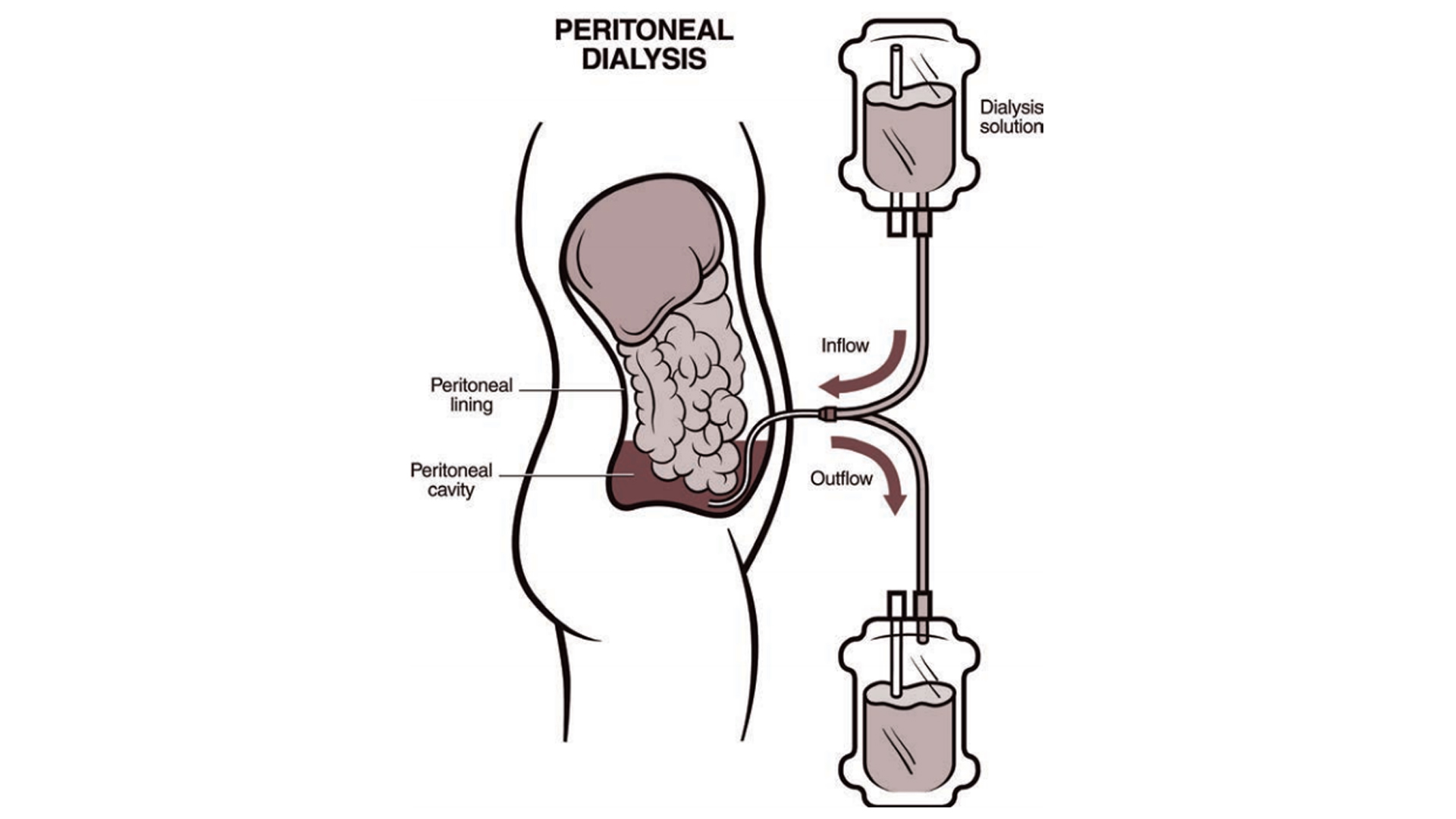 easy-and-affordable-access-to-peritoneal-dialysis-under-pmndp