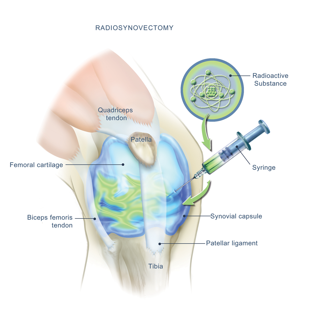 Amrita Hospitals introduces firstever RadioSynovectomy procedure for