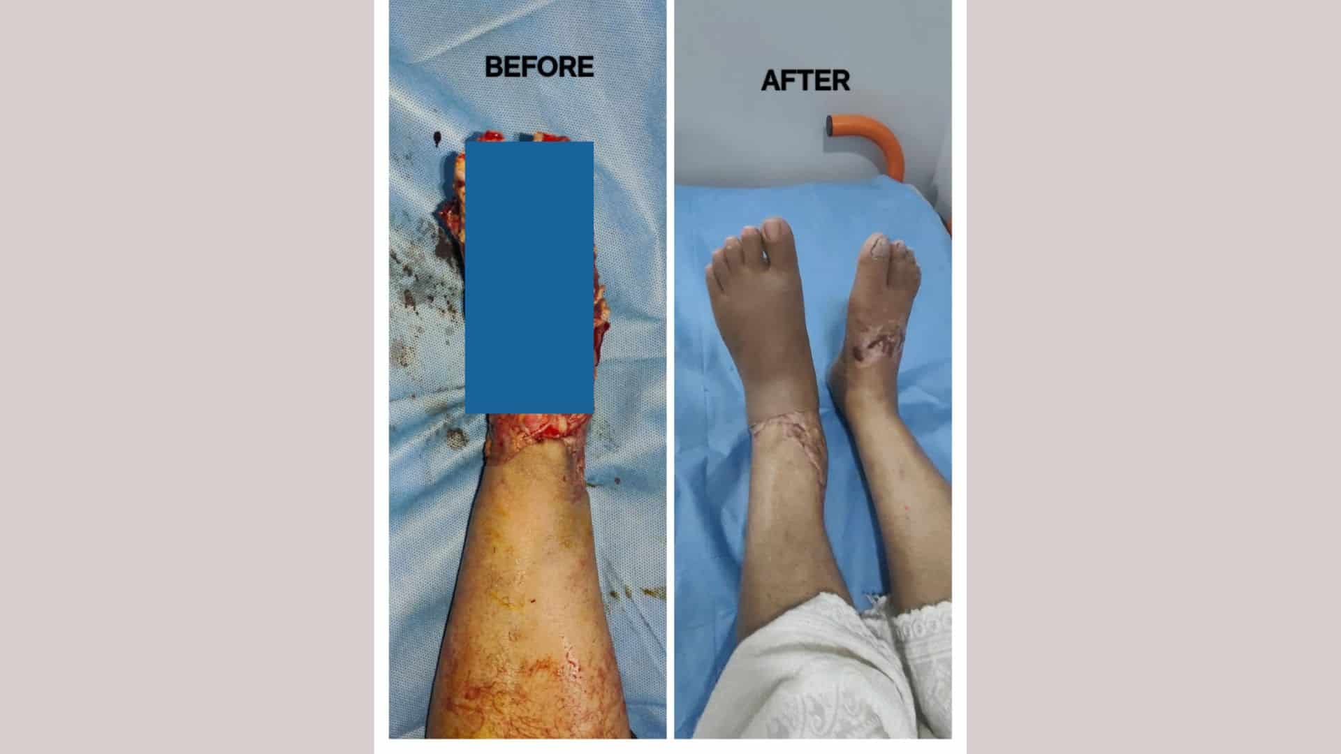 Trilife Hospital surgeons perform complex limb salvage procedure